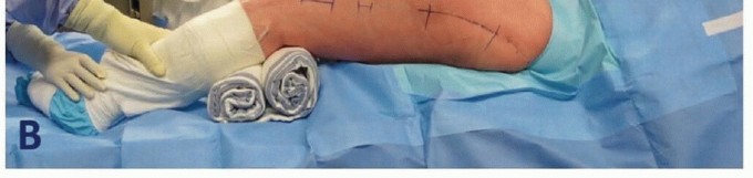 Illustration 14 for Mastering Fixation of Periprosthetic Fractures of the Femur