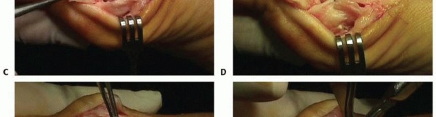 Illustration 27 for Mastering the Biplanar Distal Chevron for Effective Bunion Surgery