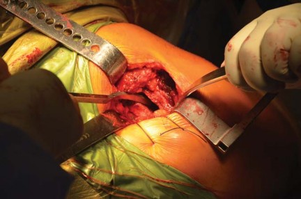 Illustration 37 for Kinectiv® Stem: Modular Necks for Primary THA Success