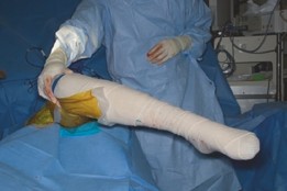 Illustration 6 for Open Hip Dislocation: How Fascia Lata Autograft Restores Stability