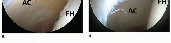 Illustration 19 for Beyond Knee Surg: Hip Arthroscopy for Sports Injuries