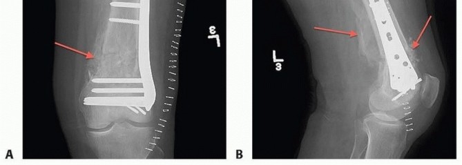 Illustration 34 for Repairing Distal Femur Fractures: Open Reduction & Internal Fixation