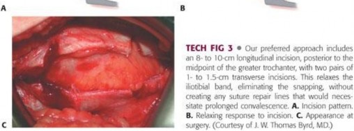 Illustration 127 for Stop the Snap: Hip Preservation for Snapping Iliopsoas Tendon
