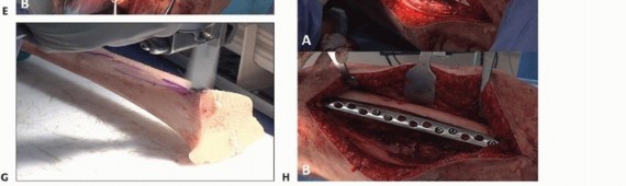 Illustration 21 for Mastering Fixation of Periprosthetic Fractures of the Femur
