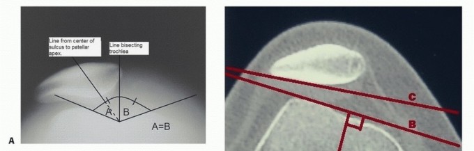 Lateral Retinacular Release: End Patellofemoral Knee Pain