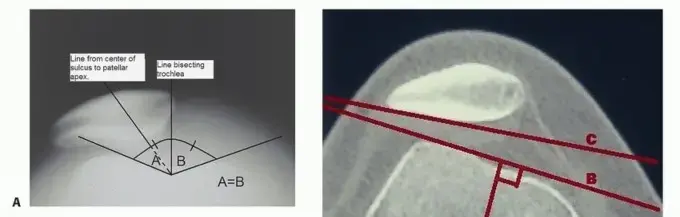 الركبة السليمة، حياة بلا ألم: دليل شامل لمتلازمة الضغط الجانبي المفرط للرضفة وعلاجها مع الأستاذ الدكتور محمد هطيف