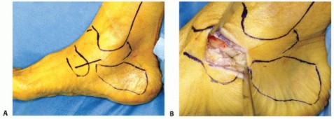 Illustration 57 for Medial Ankle Instability: Find Relief with Reconstruction