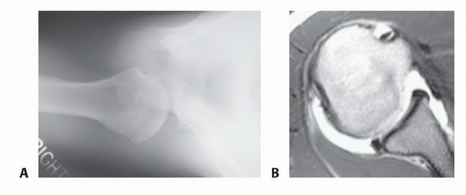 Relief for Posterior Shoulder Instability: Arthroscopic Treatment