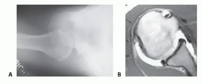 صورة توضيحية لـ عدم ثبات الكتف الخلفي: دليل شامل للمرضى نحو الشفاء مع الأستاذ الدكتور محمد هطيف