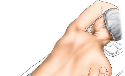 Illustration 82 for Mastering the Approach to the Distal Humerus: Safety & Skills