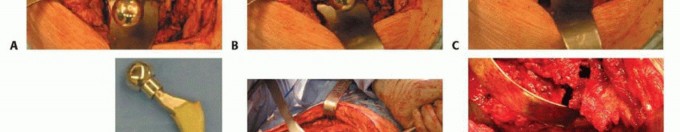 Illustration 7 for Hip Reimplantation Surgery: The Solution for Infected Implants