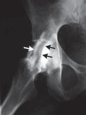 Illustration 6 for J. W. Thomas on Snapping Hip: Causes, Cures & Relief