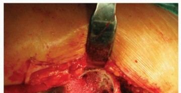 Illustration 16 for Cemented Acetabular Component: Achieving Optimal THA Stability