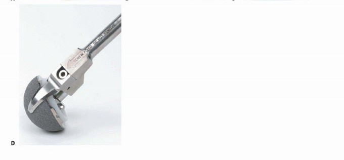 Illustration 10 for Well-Fixed THA Revisions: Precision in the Portion of the Osteotomy