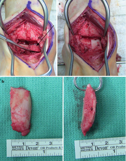Illustration 33 for First Metatarsal Surgery: Expert Solutions for Foot & Ankle Pain