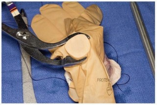 Illustration 15 for Allograft Prosthetic Composite: Mastering Proximal Femur Reconstruction