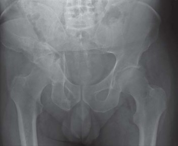Illustration 5 for Navigating Early THA for Fractures of the Acetabulum