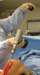 Illustration 47 for Optimal Nailing of the Tibia: Techniques for Challenging Fractures