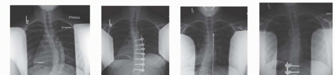 Illustration 3 for Anterior Interbody Arthrodesis for Scoliosis: What You Need to Know