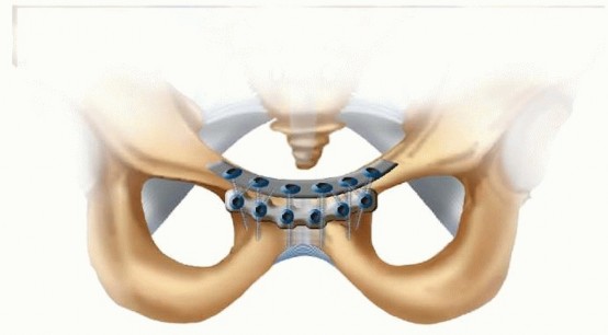 Illustration 23 for Achieve Stable Fixation of the Symphysis: Open Reduction