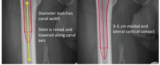 Illustration 2 for Extensively Porouscoated Stems: Proven Success & Superior Fixation