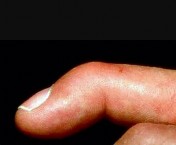 صورة طبية: دليل الأستاذ الدكتور محمد هطيف الشامل لأمراض وإصابات اليد والمعصم في صنعاء