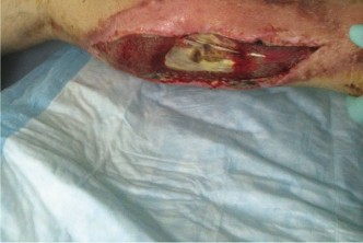 Illustration 3 for Mastering Necrotizing Soft Tissue Diagnosis with LRINEC Criteria