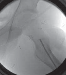 Illustration 14 for Increased Femoral Anteversion: A Proximal Femoral Rotational Osteotomy