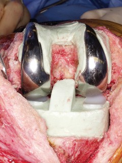 Illustration 34 for PROSTALAC Articulating Spacer: Treat Infected Knees, Regain Mobility