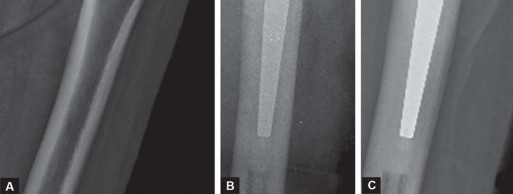 Illustration 40 for Mastering Cementing Technique Femur: A Step-by-Step Guide