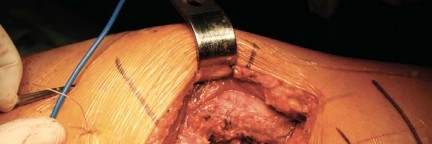 Illustration 17 for Metal on Metal Resurfacing: Enhanced Posterior Soft Tissue Repair