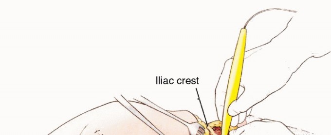 Illustration 12 for Anterior Flap Hemipelvectomy: Leveraging fig tech fig for Difficult Tumors