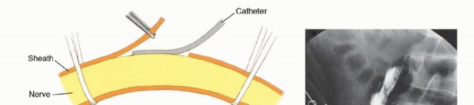 Illustration 17 for Mastering Above-Knee Amputation: Essential Surgical Insights