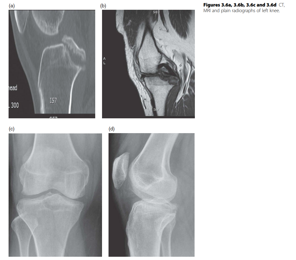 PCL Reconstruction: Treating Posterior Cruciate Ligament Avulsion