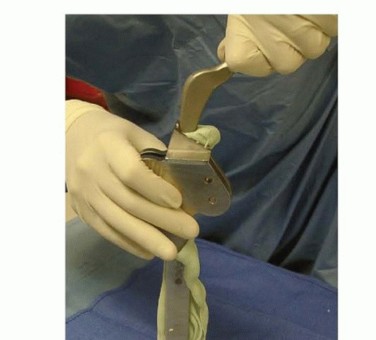 Illustration 8 for Resection Arthroplasty & Spacers: Optimizing Time of Reimplantation