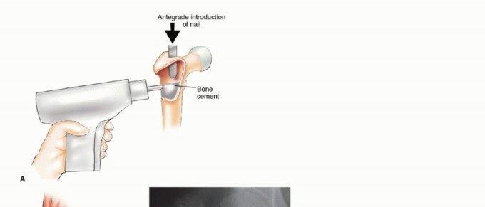 Illustration 19 for Mastering Femoral Metastases: Optimal Function for Femoris & Vastus