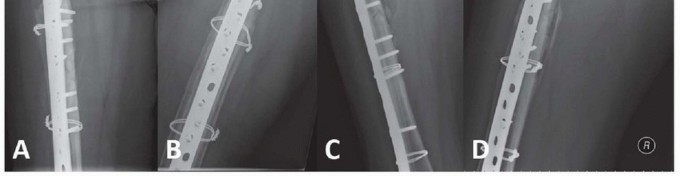 Illustration 10 for Mastering Fixation of Periprosthetic Fractures of the Femur
