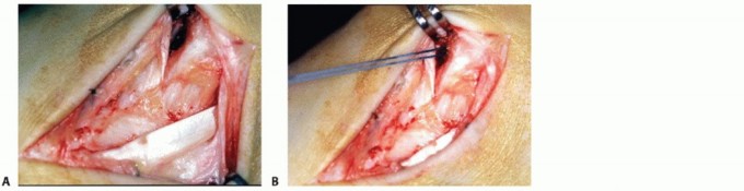 Illustration 23 for Medial Ankle Instability: Find Relief with Reconstruction