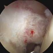 Illustration 8 for Resolve Long Head Biceps Pain: Advanced Arthroscopic Treatment