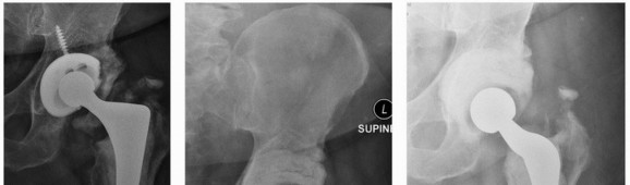Illustration 54 for Cement in Cement Revision: Simplifying Complex Hip Revisions