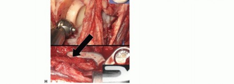 Illustration 27 for Distal Humeral Fractures: When Is Elbow Replacement the Best Option?