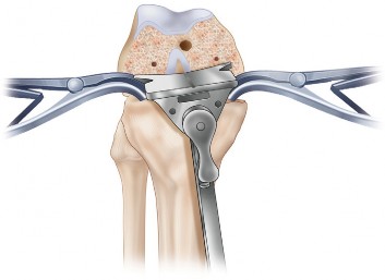 Illustration 42 for Mastering TKA: Essential Methods of Rotational Alignment