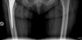 Illustration 6 for Achieving Success with Uncemented Hip Arthroplasty Metal Socket