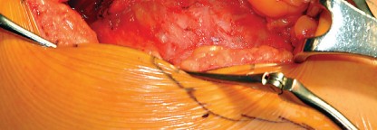 Illustration 34 for Direct Lateral Hip: Optimize Exposure with Sharp Curved Hohmann