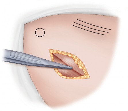 Illustration 12 for Minimally Invasive THA: Navigating Techniques, Benefits & Pitfalls