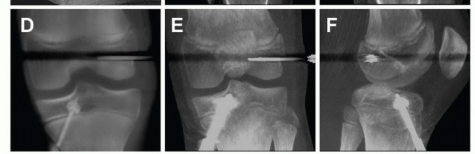 Illustration 19 for Preventing Growth Plate Risk: ACL Reconstruction Using Autogenous Grafts