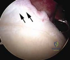 Illustration of head and glenoid - Dr. Mohammed Hutaif
