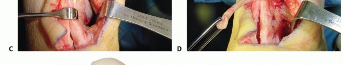 End Chronic Achilles Pain with Hallucis Longus Transfer