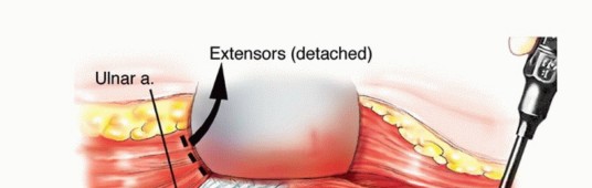 Illustration 11 for Distal Humeral Resection: Safe Techniques for Limb Preservation