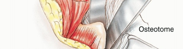 Illustration 14 for Posterior Flap Hemipelvectomy: Mastering Techniques for Optimal Outcomes